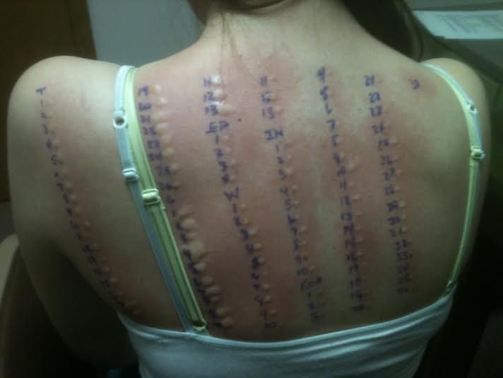 "The doctors said they had never seen someone with allergy testing results like mine. They knew something was wrong."
